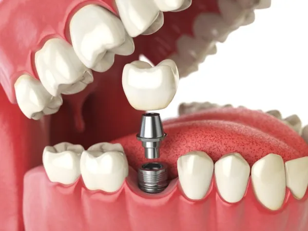 Dental Implant Services in Bellingham, WA