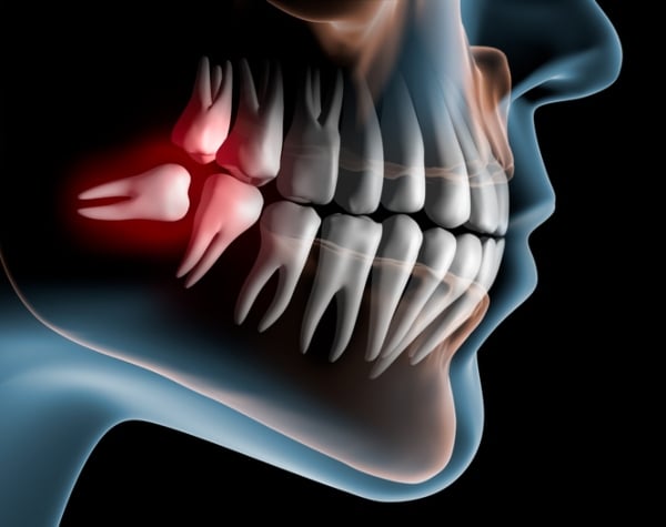 Wisdom Teeth Removal Services in Bellingham, WA