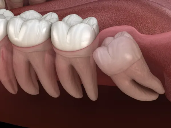 Wisdom Teeth Removal in Bellingham, WA